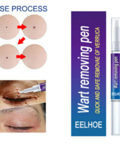 Wart removing pen