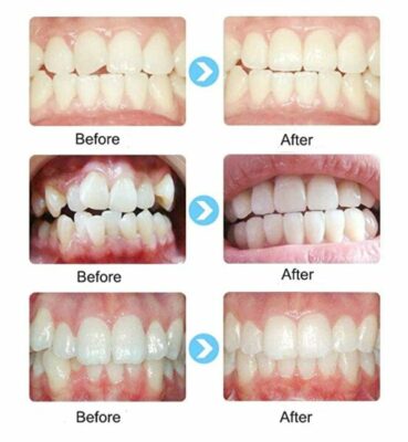 Silicon Retainer Teeth Alignment
